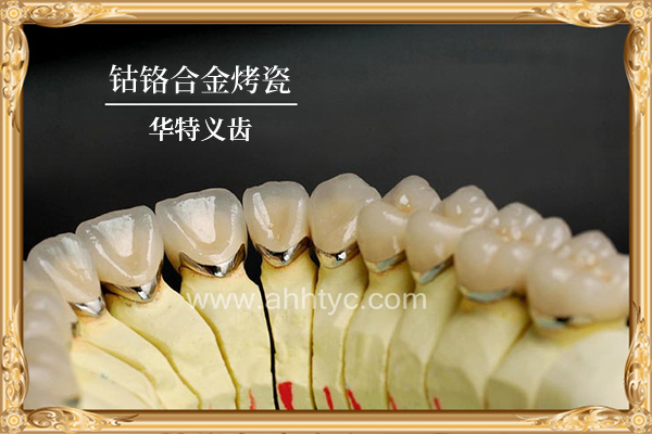 钴铬合金烤瓷