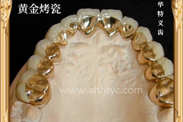 黄金烤瓷 